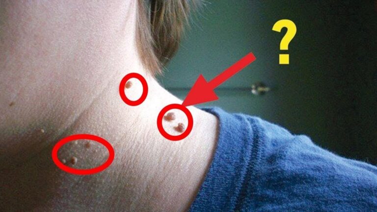 5 skutecznych sposobów na szybkie usunięcie problematycznych skórek!