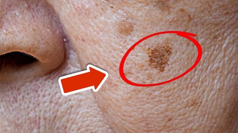 5 skutecznych sposobów na usunięcie plam starczych z twarzy w nocy