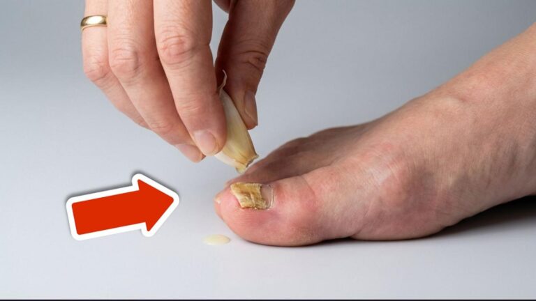 5 skutecznych sposobów na pozbycie się nagelpilzu raz na zawsze!