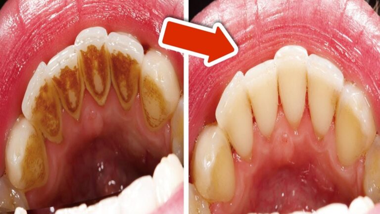 6 łatwych sposobów na usunięcie osadu nazębnego bez wizyty u dentysty